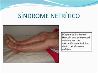 SÍNDROME NEFRÍTICO Púrpura de Schönlein-Henoch, una enfermedad autoinmune con afectación renal incluida dentro del síndrom...
