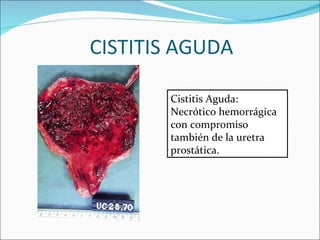 CISTITIS AGUDA Cistitis Aguda: Necrótico hemorrágica con compromiso también de la uretra prostática.  