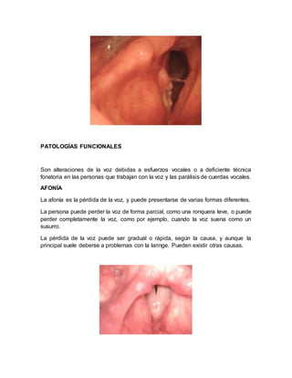 PATOLOGÍAS FUNCIONALES
Son alteraciones de la voz debidas a esfuerzos vocales o a deficiente técnica
fonatoria en las personas que trabajan con la voz y las parálisis de cuerdas vocales.
AFONÍA
La afonía es la pérdida de la voz, y puede presentarse de varias formas diferentes.
La persona puede perder la voz de forma parcial, como una ronquera leve, o puede
perder completamente la voz, como por ejemplo, cuando la voz suena como un
susurro.
La pérdida de la voz puede ser gradual o rápida, según la causa, y aunque la
principal suele deberse a problemas con la laringe. Pueden existir otras causas.
 