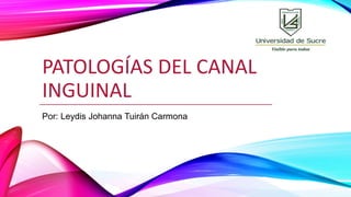 PATOLOGÍAS DEL CANAL
INGUINAL
Por: Leydis Johanna Tuirán Carmona
 