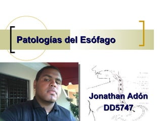 Patologías del Esófago   Jonathan Adón  DD5747  