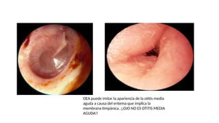 Comprehensive Overview of Acute External and Middle Ear Pathologies | PPTX