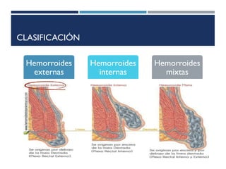 CLASIFICACIÓN
Hemorroides
externas
Se hallan en un
punto distal en
relación con la
línea dentada
Están cubiertas
por anodermo
Hemorroides
internas
Son aquellas que
se sitúan en los
dos tercios
superiores del
conducto anal
Recubiertas por
mucosa
anorrectal
insensible
Hemorroides
mixtas
Tienen de ambos
elementos tanto
internos como
externos
 