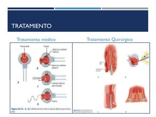 TRATAMIENTO
Tratamiento médico
 Baños de asiento calientes (primera
línea)
 Esfinterotomía química que consiste
en inyectar toxina botulínica en el
esfínter interno
Tratamiento Quirúrgico
 El objetivo de esta intervención es
disminuir el espasmo del esfínter interno
tras cortar una porción del músculo. Se
secciona de forma lateral alrededor de 30%
de las fibras del esfínter interno
 Esfinterotomía interna lateral abierta o
cerrada
 