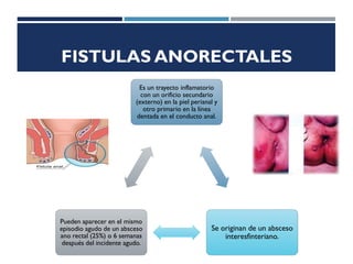 FISTULAS ANORECTALES
Es un trayecto inflamatorio
con un orificio secundario
(externo) en la piel perianal y
otro primario en la línea
dentada en el conducto anal.
Se originan de un absceso
interesfinteriano.
Pueden aparecer en el mismo
episodio agudo de un absceso
ano rectal (25%) o 6 semanas
después del incidente agudo.
 