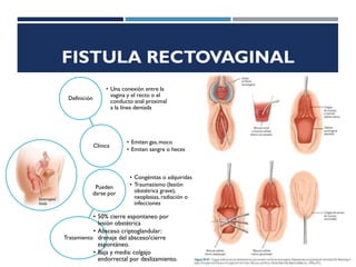 FISTULA RECTOVAGINAL
Definición
• Una conexión entre la
vagina y el recto o el
conducto anal proximal
a la línea dentada
Clínica
• Emiten gas,moco
• Emiten sangre o heces
Pueden
darse por
• Congénitas o adquiridas
• Traumatismo (lesiòn
obstétrica grave),
neoplasias, radiación o
infecciones
Tratamiento
• 50% cierre espontaneo por
lesión obstétrica
• Absceso criptoglandular:
drenaje del absceso/cierre
espontáneo.
• Baja y media: colgajo
endorrectal por deslizamiento.
 