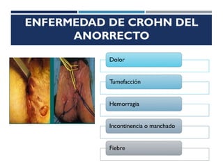 ENFERMEDAD DE CROHN DEL
ANORRECTO
Dolor
Tumefacción
Hemorragia
Incontinencia o manchado
Fiebre
 