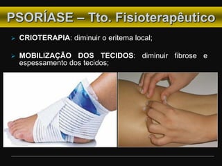  CRIOTERAPIA: diminuir o eritema local;
 MOBILIZAÇÃO DOS TECIDOS: diminuir fibrose e
espessamento dos tecidos;
PSORÍASE – Tto. Fisioterapêutico
 