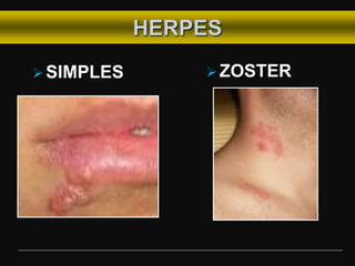 HERPES
SIMPLES ZOSTER
 