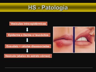 HS - Patologia
Vesículas intra-epidérmicas
Epiderme e Derme c/ leucócitos
Exsudato + células disassociadas
Vesícula (abaixo do estrato córneo)
 