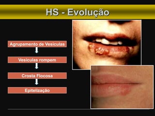HS - Evolução
Agrupamento de Vesículas
Vesículas rompem
Crosta Flocosa
Epitelização
 
