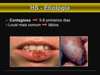 HS - Etiologia
 Contagiosa 5-8 primeiros dias
Local mais comum lábios
 