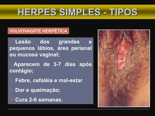 HERPES SIMPLES - TIPOS
VULVOVAGIITE HERPÉTICA
 Lesão dos grandes e
pequenos lábios, área perianal
ou mucosa vaginal;
Aparecem de 3-7 dias após
contágio;
 Febre, cefaléia e mal-estar
 Dor e queimação;
 Cura 2-6 semanas.
 