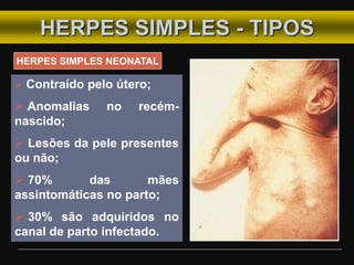 HERPES SIMPLES - TIPOS
HERPES SIMPLES NEONATAL
 Contraído pelo útero;
 Anomalias no recém-
nascido;
 Lesões da pele presentes
ou não;
 70% das mães
assintomáticas no parto;
 30% são adquiridos no
canal de parto infectado.
 