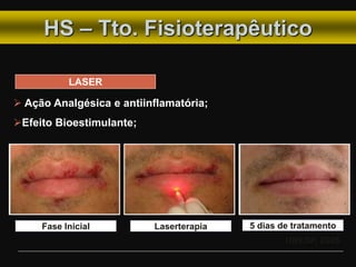 HS – Tto. Fisioterapêutico
LASER
 Ação Analgésica e antiinflamatória;
Efeito Bioestimulante;
5 dias de tratamentoLaserterapiaFase Inicial
UNESP, 2005
 