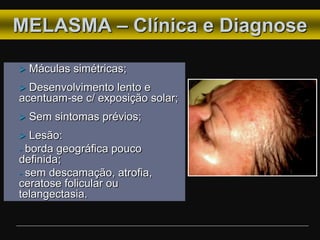 MELASMA – Clínica e Diagnose
 Máculas simétricas;
 Desenvolvimento lento e
acentuam-se c/ exposição solar;
 Sem sintomas prévios;
 Lesão:
- borda geográfica pouco
definida;
- sem descamação, atrofia,
ceratose folicular ou
telangectasia.
 