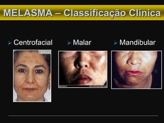 MELASMA – Classificação Clínica
 Centrofacial  Malar  Mandibular
 