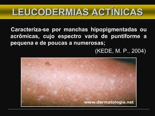 LEUCODERMIAS ACTÍNICAS
Caracteriza-se por manchas hipopigmentadas ou
acrômicas, cujo espectro varia de puntiforme a
pequena e de poucas a numerosas;
(KEDE, M. P., 2004)
 