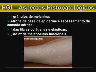 HGI – Aspectos Histopatológicos
 ↓ grânulos de melanina;
 Atrofia da base da epiderme e espessamento da
camada córnea;
 ↑ das fibras colágenas e elásticas;
 ↓ no nº de melanócitos funcionais.
 
