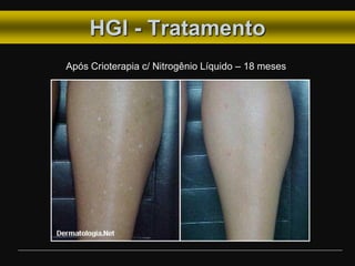 HGI - Tratamento
Após Crioterapia c/ Nitrogênio Líquido – 18 meses
 