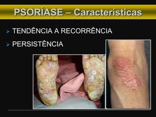 PSORÍASE – Características
 TENDÊNCIA A RECORRÊNCIA
 PERSISTÊNCIA
 