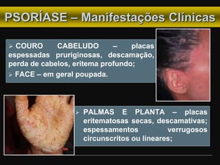 PSORÍASE – Manifestações Clínicas
 COURO CABELUDO – placas
espessadas pruriginosas, descamação,
perda de cabelos, eritema profundo;
 FACE – em geral poupada.
 PALMAS E PLANTA – placas
eritematosas secas, descamativas;
espessamentos verrugosos
circunscritos ou lineares;
 