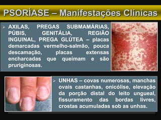  AXILAS, PREGAS SUBMAMÁRIAS,
PÚBIS, GENITÁLIA, REGIÃO
INGUINAL, PREGA GLÚTEA – placas
demarcadas vermelho-salmão, pouca
descamação, placas extensas
encharcadas que queimam e são
pruriginosas.
 UNHAS – covas numerosas, manchas
ovais castanhas, onicólise, elevação
da porção distal do leito ungueal,
fissuramento das bordas livres,
crostas acumuladas sob as unhas.
PSORÍASE – Manifestações Clínicas
 