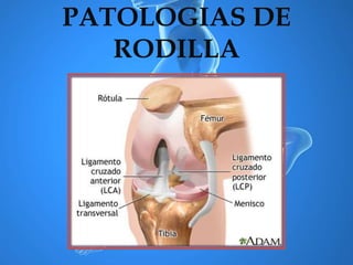 PATOLOGIAS DE
RODILLA
 
