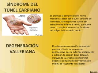 SÍNDROME DEL 
TÚNEL CARPIANO 
Se produce la compresión del nervio 
mediano al pasar por el túnel carpiano de 
la muñeca. Este espacio se vuelve tan 
estrecho que inflama el nervio y produce 
dolor o complicaciones en las funciones 
del pulgar, índice y dedo medio. 
El aplastamiento o sección de un axón 
provoca el inicio de un proceso 
degenerativo que se extiende distalmente 
a la lesión, la porción distal del axón, 
incluyendo su arborización terminal, 
degenera completamente y la vaina de 
mielina se fragmenta y reabsorbe 
DEGENERACIÓN 
VALLERIANA 
 