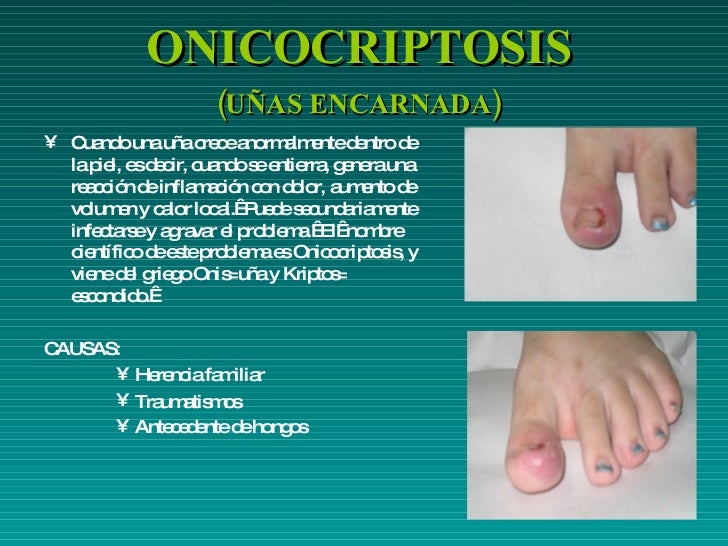 El mejor medio del hongo de las uñas y los altos