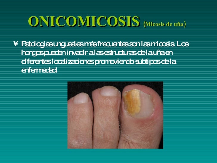 La enfermedad de las uñas de los pies el hongo