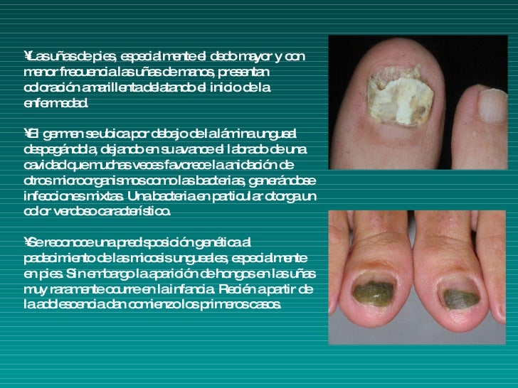 Como luchar con el hongo sobre las uñas de los pies el foro