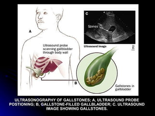 ULTRASONOGRAPHY OF GALLSTONES; A, ULTRASOUND PROBE POSTIONING; B, GALLSTONE-FILLED GALLBLADDER; C. ULTRASOUND IMAGE SHOWING GALLSTONES. 