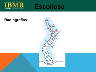Radiografias
Escoliose
 