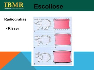Radiografias
Escoliose
• Risser
 