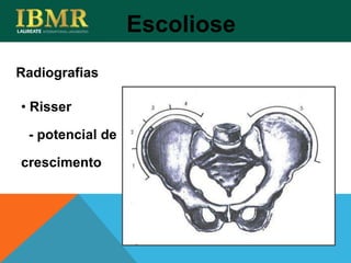 Radiografias
Escoliose
• Risser
- potencial de
crescimento
 