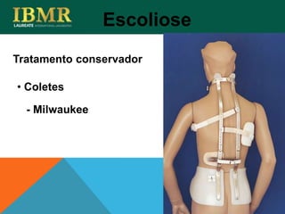 Tratamento conservador
Escoliose
• Coletes
- Milwaukee
 