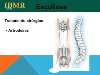 Tratamento cirúrgico
Escoliose
• Artrodeses
 