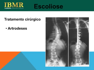 Tratamento cirúrgico
Escoliose
• Artrodeses
 