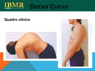 Quadro clínico
Dorso Curvo
 