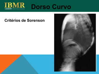 Critérios de Sorenson
Dorso Curvo
 