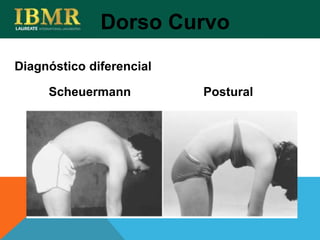 Diagnóstico diferencial
Dorso Curvo
Scheuermann Postural
 