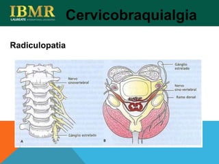 Radiculopatia
Cervicobraquialgia
 