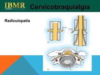 Radiculopatia
Cervicobraquialgia
 
