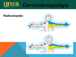 Radiculopatia
Cervicobraquialgia
 