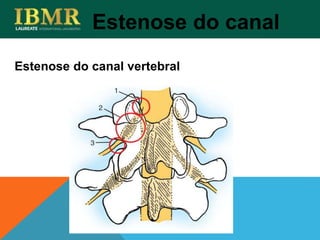 Estenose do canal
Estenose do canal vertebral
 
