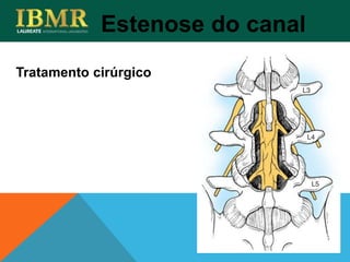 Tratamento cirúrgico
Estenose do canal
 