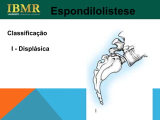 Espondilolistese
I - Displásica
Classificação
 