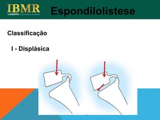 Espondilolistese
I - Displásica
Classificação
 