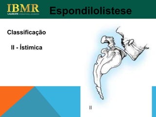 Espondilolistese
II - Ístimica
Classificação
 